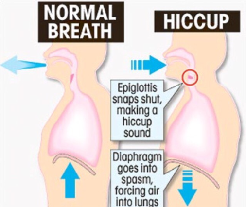 how to stop hiccups after drinking alcohol